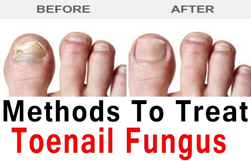Toenail Fungal Infection
