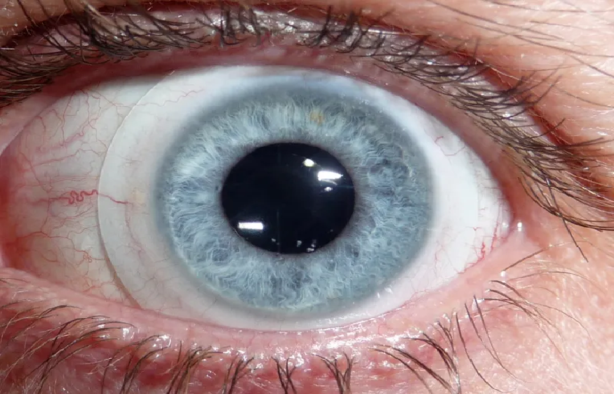 What is it like to have Keratoconus?